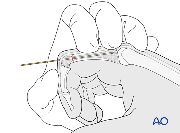 Intramedullary screw fixation of a transverse fracture of the proximal phalangeal end segment – Guide-wire insertion