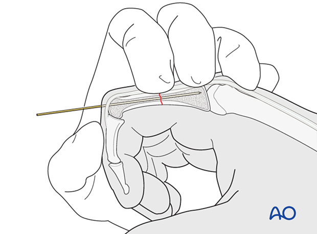 Intramedullary screw fixation of a transverse fracture of the proximal phalangeal shaft – Guide-wire insertion