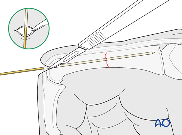 Intramedullary screw fixation of a transverse fracture of the proximal phalangeal shaft – skin incision