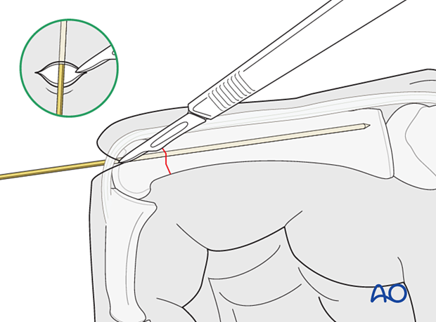 Intramedullary screw fixation of a transverse fracture of the proximal phalangeal end segment – skin incision