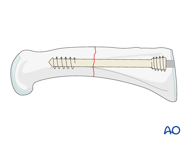 Intramedullary screw fixation of a transverse fracture of the proximal phalangeal shaft