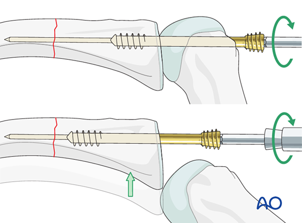 Intramedullary screw fixation of a transverse fracture of the proximal phalangx with antegrade screw insertion in a trans- and intraarticular fashion