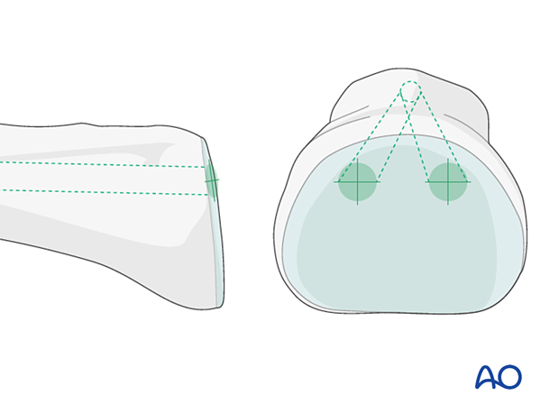 Insertion points for antegrade intramedullary screw fixation of proximal phalangeal fractures