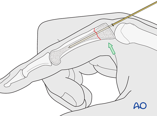 Intramedullary screw fixation of a transverse fracture of the proximal phalangeal proximal end segment – Guide-wire insertion for an antegrade intraarticular screw