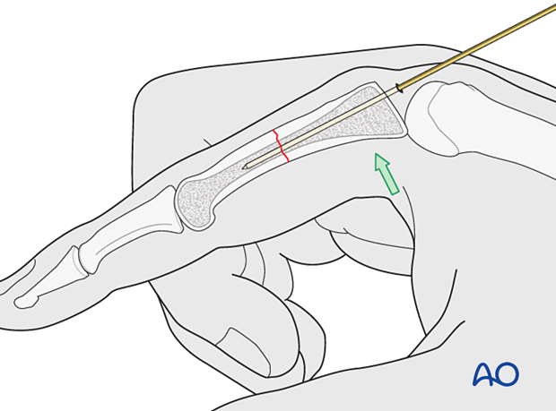 Intramedullary screw fixation of a transverse fracture of the proximal phalangeal shaft – Guide-wire insertion for an antegrade intraarticular screw