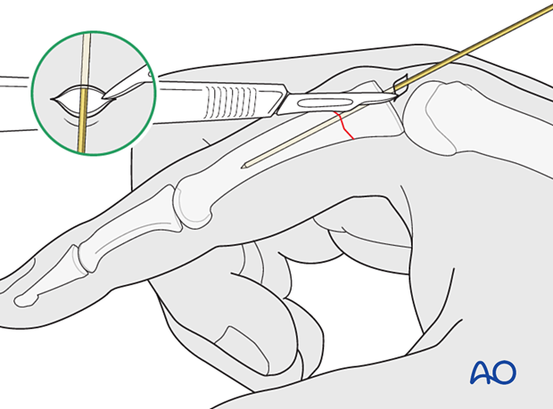 Intramedullary screw fixation of a transverse fracture of the proximal phalangeal proximal end segment – Skin incision for an antegrade intraarticular screw