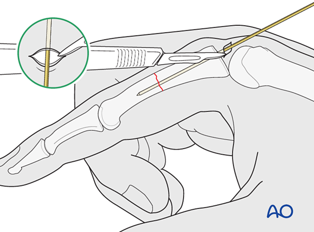 Intramedullary screw fixation of a transverse fracture of the proximal phalangeal shaft – Skin incision for an antegrade intraarticular screw