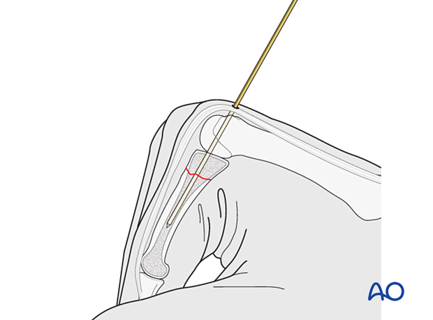 Intramedullary screw fixation of a transverse fracture of the proximal phalangeal proximal end segment – Guide-wire insertion for an antegrade transarticular screw