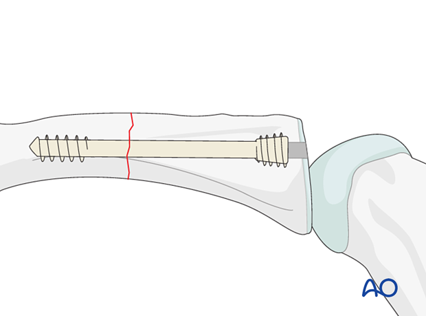 Intramedullary screw fixation of a transverse fracture of the proximal phalangeal shaft – Antegrade intraarticular screw insertion