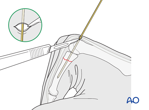 Intramedullary screw fixation of a transverse fracture of the proximal phalangeal proximal end segment – skin incision for an antegrade transarticular screw