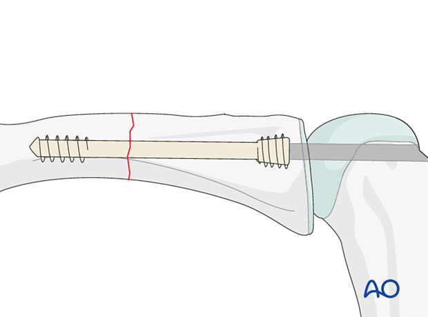 Intramedullary screw fixation of a transverse fracture of the proximal phalangeal shaft – Antegrade transarticular screw insertion