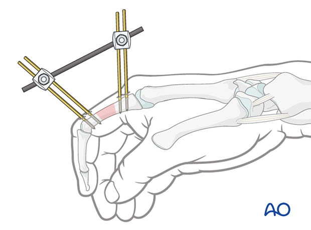 Final construction of the external fixation of diaphyseal wedge or multifragmentary fractures – proximal phalanx – hand.