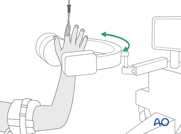 Finger in finger traps and position of a small image intensifier