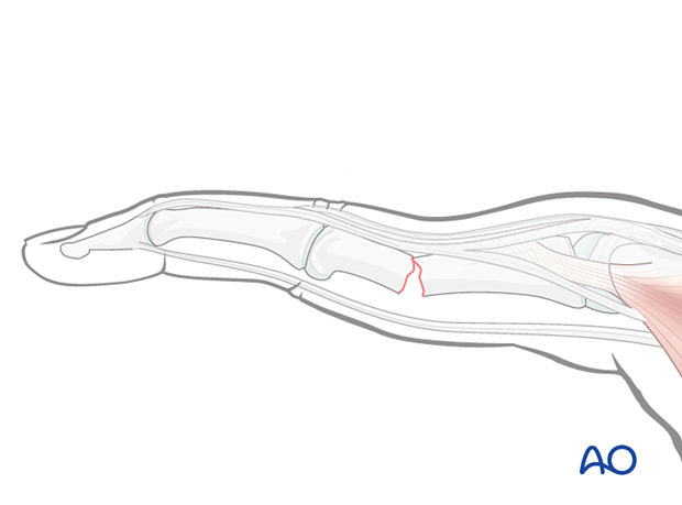 Dorsal angular deformity in a proximal phalangeal shaft fracture