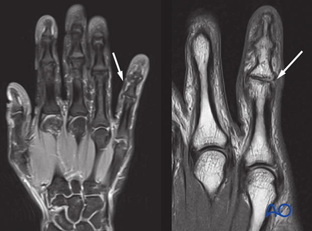 MRI of a ligamentous injury at the proximal interphalangeal joint of the 5th finger