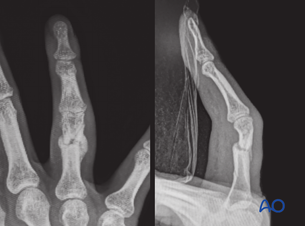 Malunion of a proximal phalangeal fracture