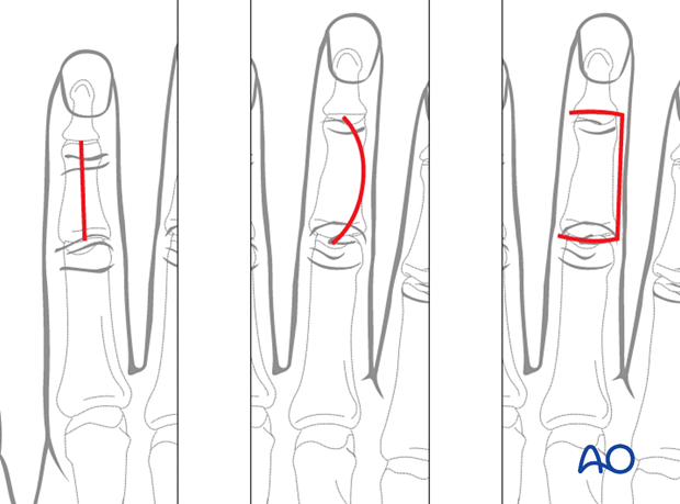 Illustration showing dorsal approach to the middle phalanx, accessing the extensor tendon, metaphysis, and diaphysis.
