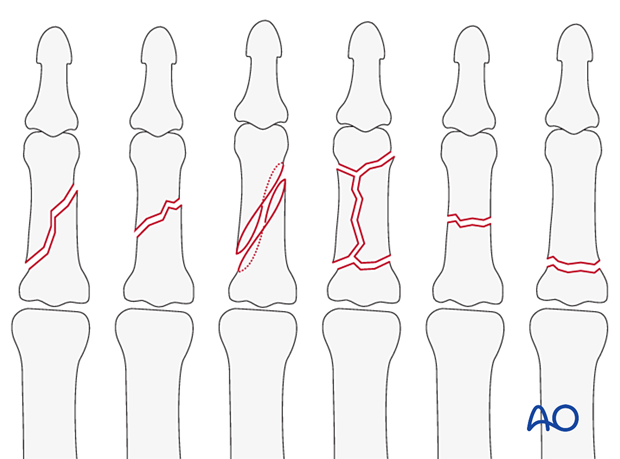Illustration showing dorsal approach to the middle phalanx, indicated for various fractures and corrective osteotomies.