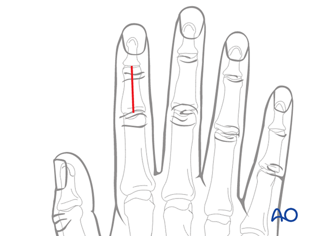 Illustration showing dorsal approach to the middle phalanx with a straight midline incision from PIP to DIP joint. Advantages: preserved perfusion and venous drainage, early motion. Disadvantages: potential scarring and limited lateral access.