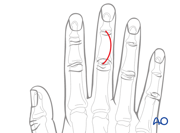 Illustration showing dorsal approach to the middle phalanx with a curved skin incision from PIP to DIP joint, avoiding radial and ulnar borders.