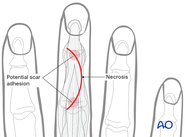 Illustration showing dorsal approach to the middle phalanx, avoiding scarring in the same line but risking poor perfusion at the curve's apex.