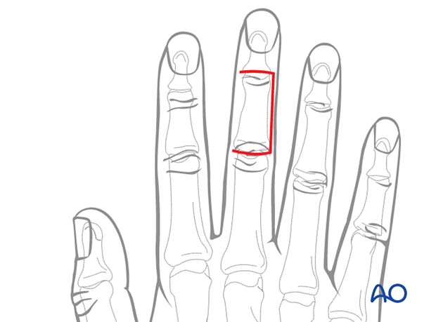 Illustration showing dorsal approach to the middle phalanx with a transverse incision at DIP joint crease, curving over PIP joint crease, avoiding neurovascular bundle, and preserving sensitivity. Advantages: low risk of scar adhesion, apical flap necrosis, and better esthetic result.