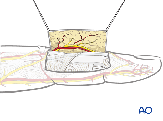 Illustration showing dorsal approach to the middle phalanx, elevating fasciocutaneous flap, retracting with sutures, preserving nerves and veins.