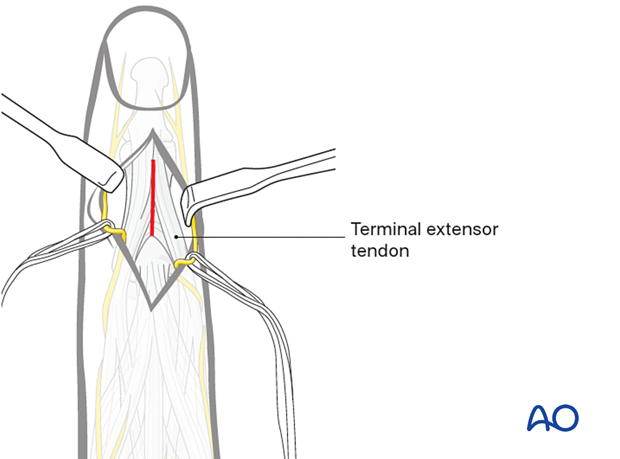 Illustration showing dorsal approach to the middle phalanx, exposing and incising terminal extensor tendon and triangular ligament, preserving periosteum, avoiding nail matrix injury and mallet finger deformity.