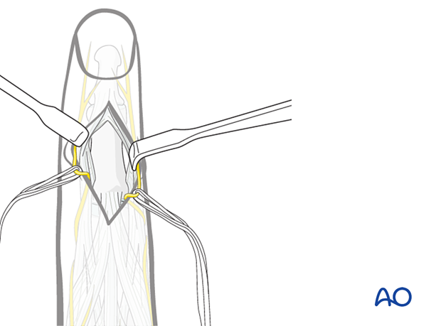 Illustration showing dorsal approach to the middle phalanx, using two small retractors to expose the bone after incising the terminal extensor tendon and triangular ligament.
