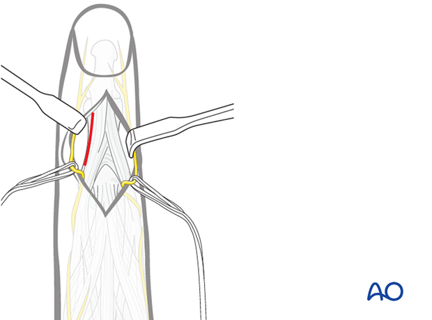 Illustration showing dorsal approach to the middle phalanx, incising between lateral band and central slip, avoiding nail matrix injury.