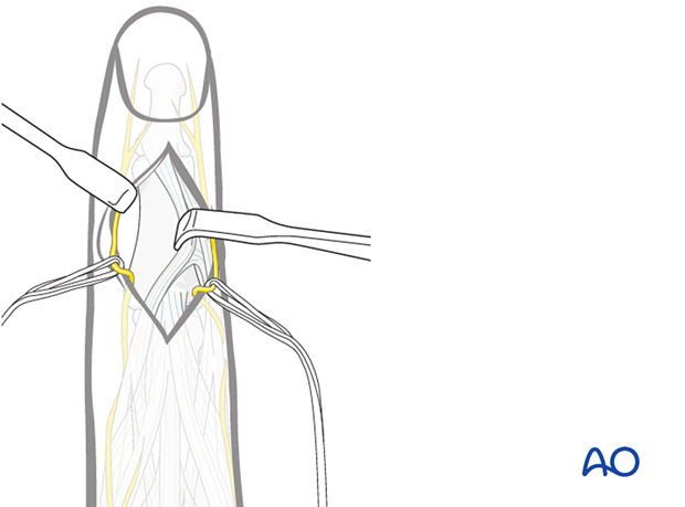Illustration showing dorsal approach to the middle phalanx, retracting extensor tendon towards midline based on fracture pattern and fixation needs.