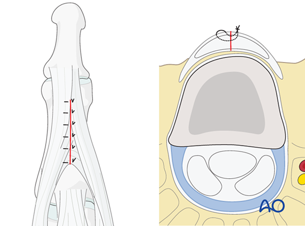 Illustration showing dorsal approach to the middle phalanx, repairing tendon incisions with nonabsorbable sutures before wound closure, using specific suture dimensions, and covering metallic implants with periosteum.