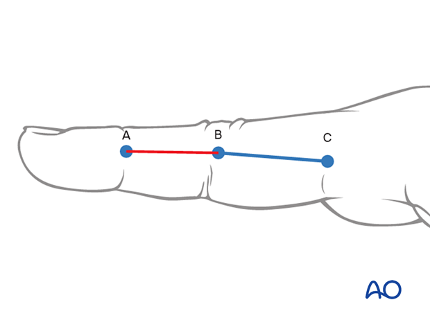 Illustration showing midaxial approach to the middle phalanx, accessing midaxial ligaments, proximal phalanx, and proximal and distal end seg-ments. Incision may need to be enlarged distally for articular fractures of the head.