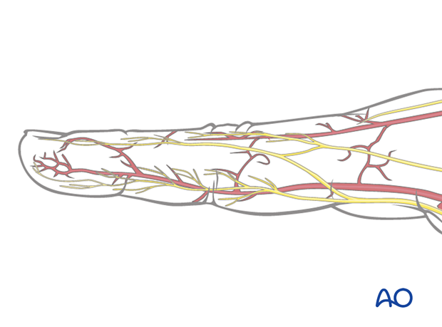 Illustration showing midaxial approach to the middle phalanx, with digital artery and nerve palmar to midaxial line, collateral to flexor tendon sheath.
