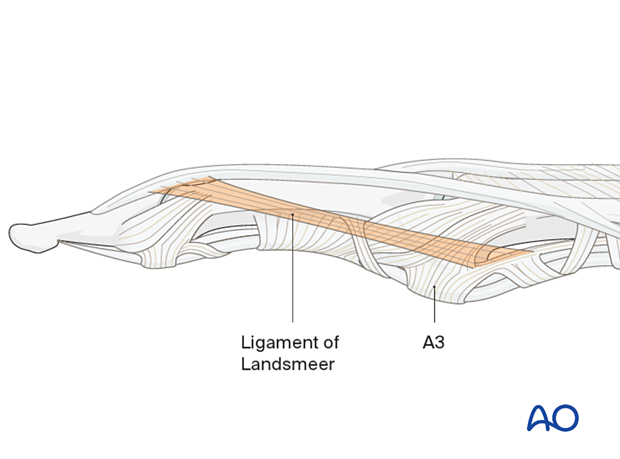 Illustration showing midaxial approach to the middle phalanx, preserving or carefully repairing the oblique retinacular ligament of Landsmeer to avoid mallet deformity.