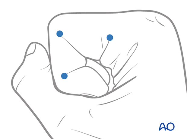 Illustration showing midaxial approach to the middle phalanx, fully flexing the finger and marking dorsal ends of flexor creases with dots.