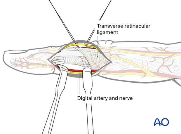 Illustration showing midaxial approach to the middle phalanx, elevating subcutaneous tissues, protecting digital vessels and nerve, and exposing the transverse retinacular ligament (TRL).