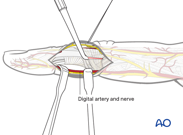 Midaxial approach to middle phalanx, divide TRL with dental pick between it and collateral ligament to avoid cutting ligament.