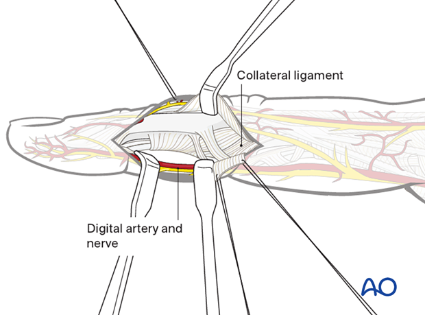 Midaxial approach to middle phalanx, elevate dorsal fringe of TRL with lateral band to expose collateral ligament. Retract palmar TRL with sutures to expose fracture extraperiosteally. Elevate periosteum near fracture line.