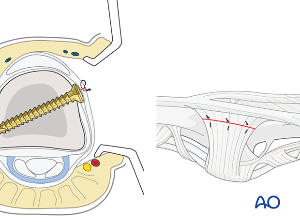 Midaxial approach to middle phalanx, repair tendon incisions with nonabsorbable sutures before wound closure. Use 4.0 sutures for central tendon repair and 6.0 for ligament and periosteum repair. Cover metallic implants with periosteum to minimize contact with extensor tendons.