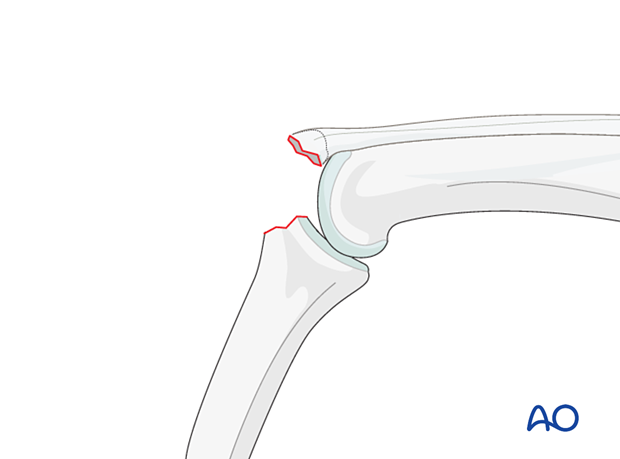 Dorsal avulsion of the middle phalanx base, classified as 78.2–5.2.1B, may be simple or fragmentary, and associated with PIP joint dislocation.