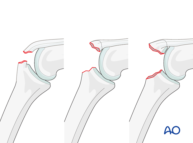 Dorsal avulsion of the middle phalanx, hyperflexion detachment (no fracture), simple avulsion with small nonarticular or larger partial articular fragment.
