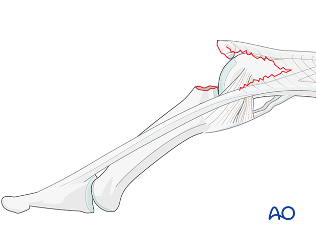 Dorsal avulsion of the middle phalanx, often confused with ligament sprains, but boutonnière deformity needs acute treatment.