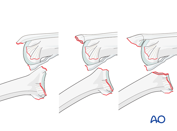 Dorsal avulsion of the middle phalanx, palmar PIP dislocation involves collateral ligament rupture and central slip detachment, causing swan-neck deformity. Lesions include central slip detachment (no fracture), avulsion fracture with small nonarticular fragment, or larger partial articular fragment