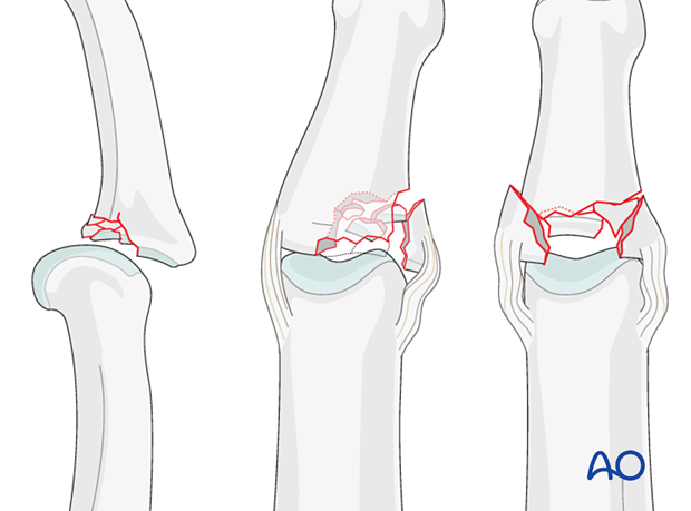 Illustration showing multifragmentary articular fracture of middle phalangeal base with possible PIP joint dislocation. Fracture types: central and palmar impaction, lateral plateau compression, complete articular, pilon compression.