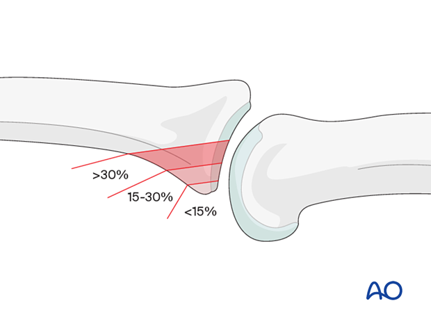 Illustration showing multifragmentary articular fracture of middle phalangeal base with stability decreasing as impaction and comminution increase: <15% stable, 15–30% mildly unstable, >30% unstable.