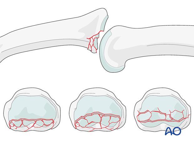 Illustration showing multifragmentary articular fracture of middle phalangeal base with impaction in volar ring, up to 50% of palmar joint aspect, or central section of joint.