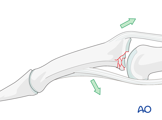 Illustration showing multifragmentary articular fracture of middle phalangeal base with palmar instability of PIP joint, leading to palmar tilting and dorsal subluxation due to muscle forces.