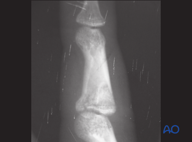 Lateral x-ray showing palmar impaction fracture of middle phalangeal base with minimal displacement.