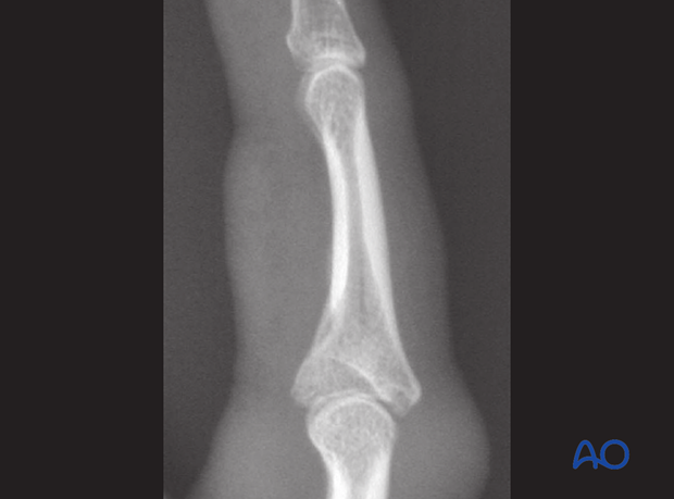 Lateral x-ray showing palmar impaction fracture of middle phalangeal base with depression of articular surface.